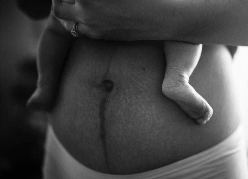 Caesarean section scar on a mothers stomach with stretch marks holding baby in greyscale; highlighting the potential of NKT to treat scars