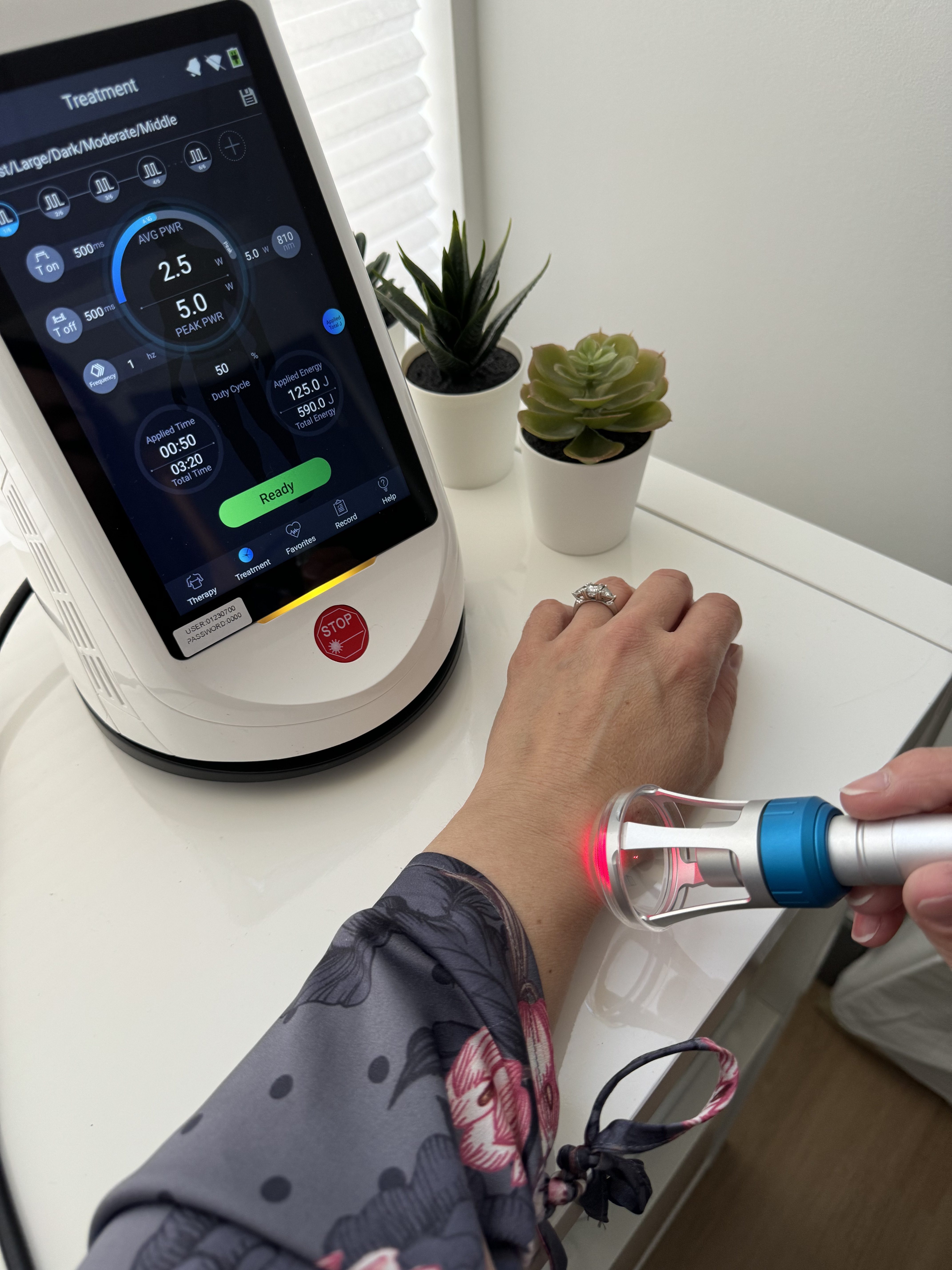 a patients hand and wrist with the Cold Laser Therapy handheld laser pointed at the wrist and the machine in the background turned on to the treatment screen. 